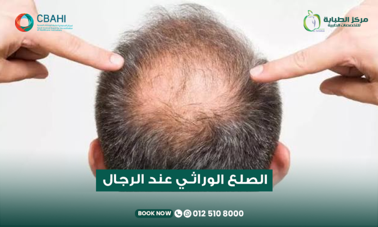 علاج الصلع الوراثي المبكر عند الرجال في مركز الطبابة