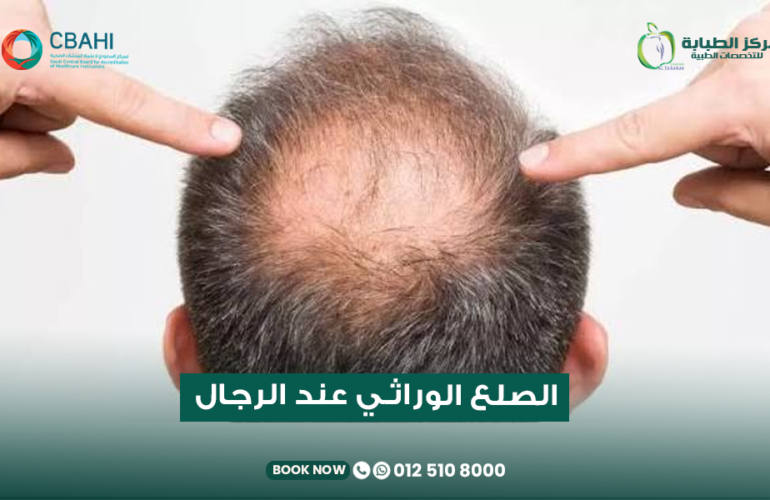 علاج الصلع الوراثي المبكر عند الرجال في مركز الطبابة