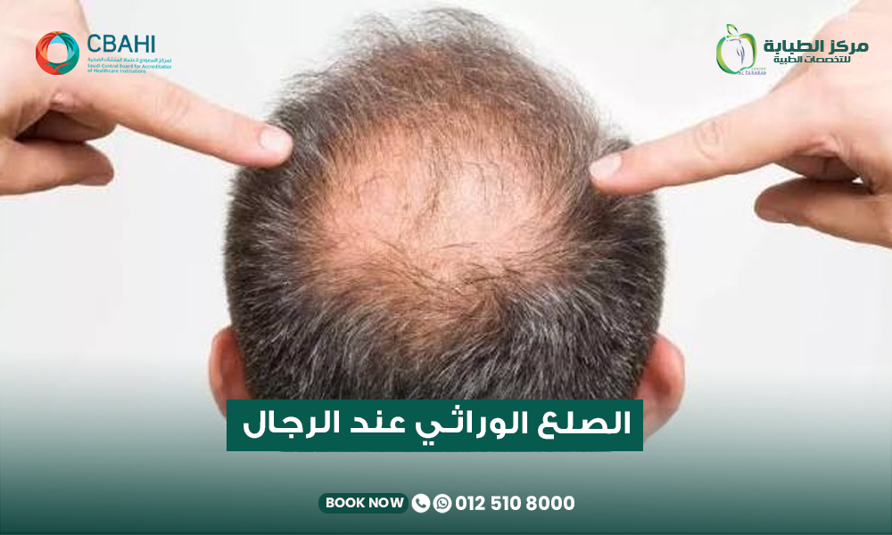 علاج الصلع الوراثي المبكر عند الرجال في مركز الطبابة