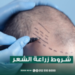 شروط زراعة الشعر