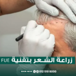 زراعة الشعر بتقنيةfue
