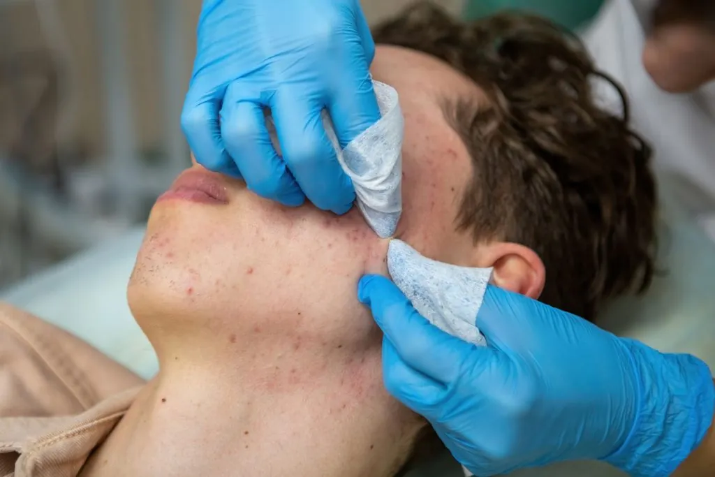 acne treatment in a teenager 2026 03 15 23 23 23 utc
