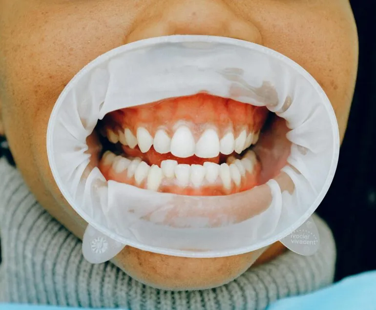 dental white