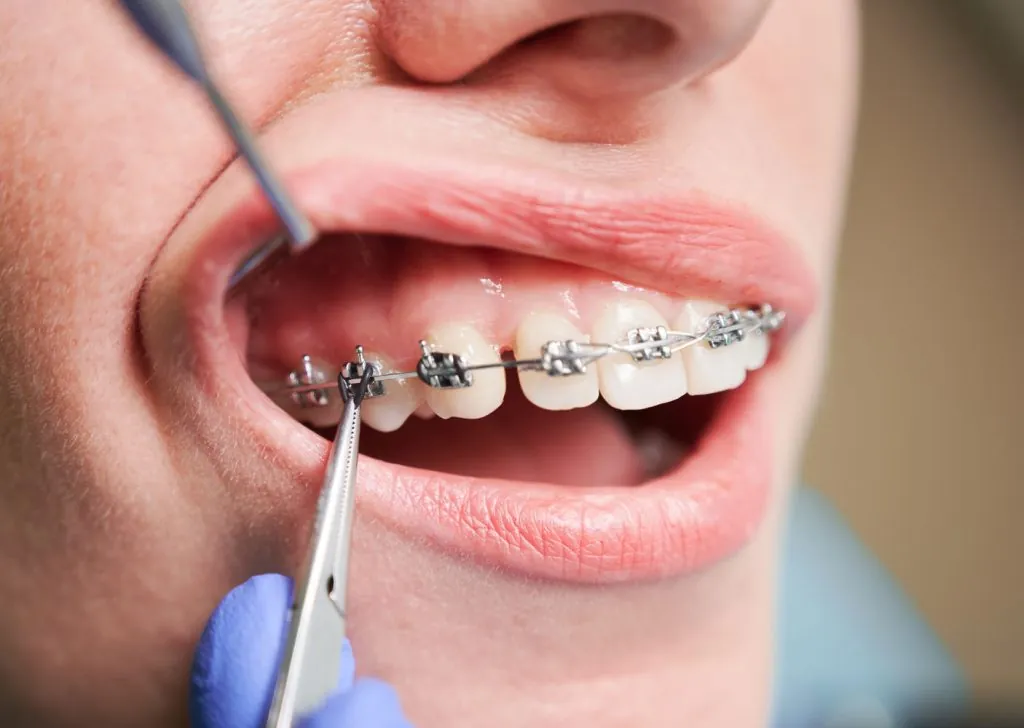 dentist placing braces on female patient teeth 2026 03 17 01 39 59 utc