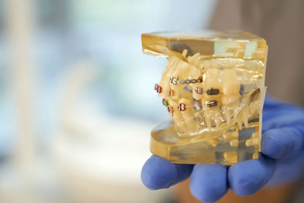 fragment photo of set of teeth with braces system 2026 03 24 03 30 07 utc