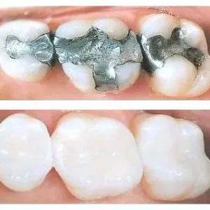 White fillings 300x300 1