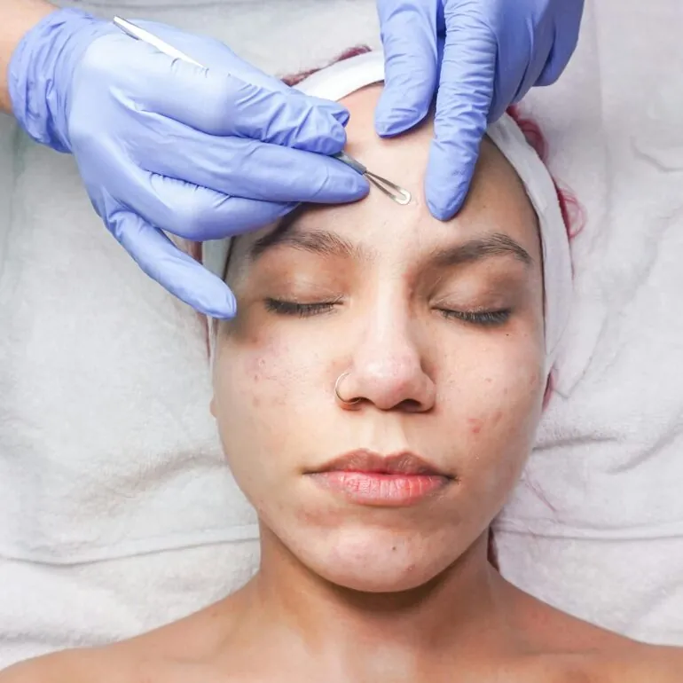 دكتور لعلاج حب الشباب في جدة 9 acne