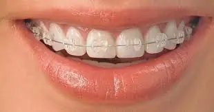 التقويم الشفاف (الانفزلاين)_اهم ميزات يجب عليك معرفتها 25 download 1 2