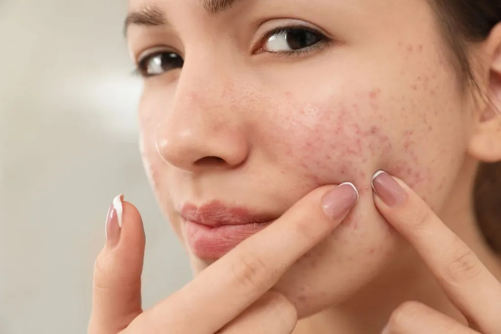 teen girl with acne problem squeezing pimple on he 2026 03 26 23 59 19 utc