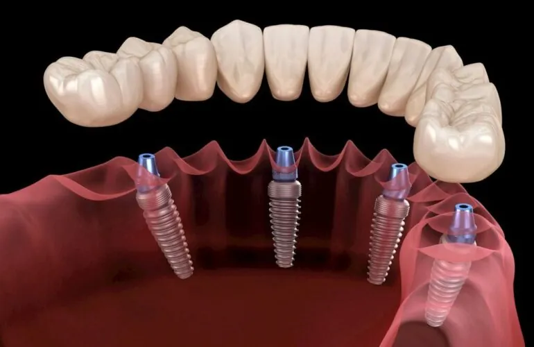 فشل زرعة الاسنان