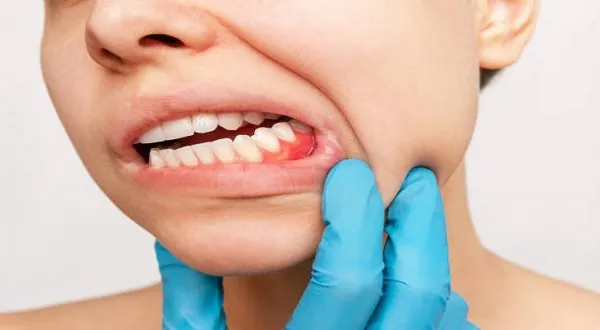 علامات فشل علاج جذور الاسنان