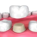 اسباب سقوط تلبيسات الاسنان