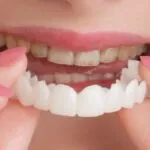 الفرق بين الفينير المباشر والفينير الغير مباشر