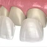 تركيبات اسنان البورسلان