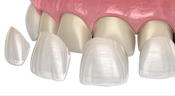 تركيبات اسنان البورسلان