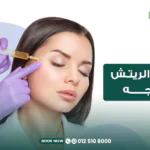 إبرة الريتش للوجه في مركز الطبابة
