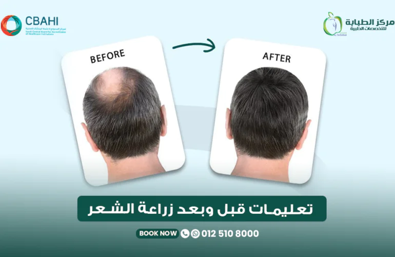 تعليمات قبل وبعد زراعة الشعر