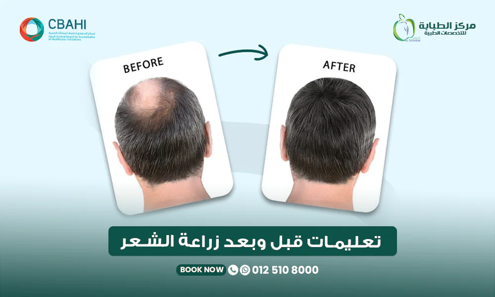 تعليمات قبل وبعد زراعة الشعر