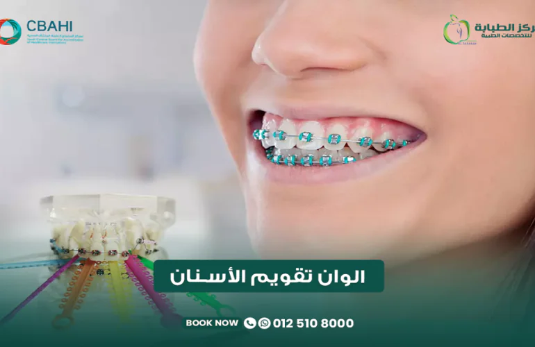 ألوان تقويم الأسنان