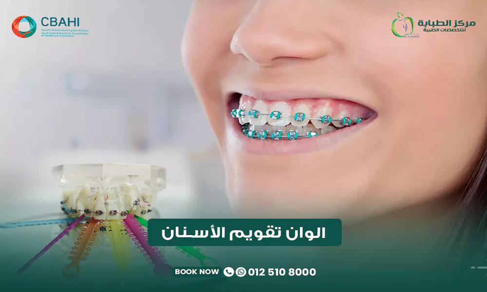 ألوان تقويم الأسنان