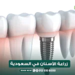 زراعة الأسنان في السعودية بمركز الطبابة