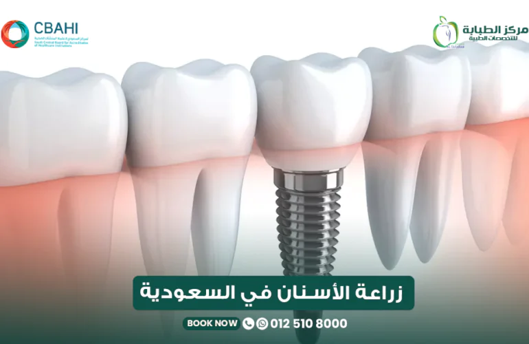 زراعة الأسنان في السعودية بمركز الطبابة