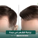 زراعة الشعر في جدة