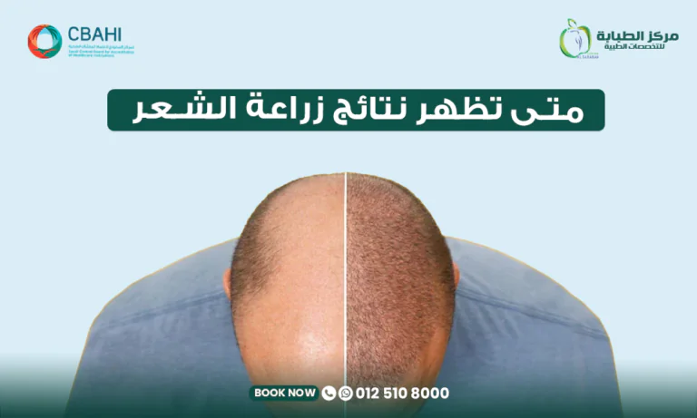متى تظهر نتائج زراعة الشعر