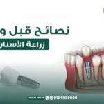 نصائح قبل وبعد زراعة الأسنان