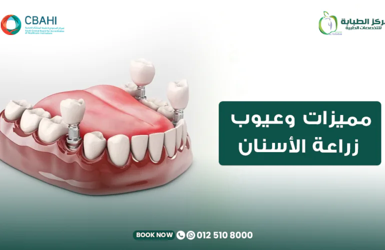 مميزات وعيوب زراعة الأسنان