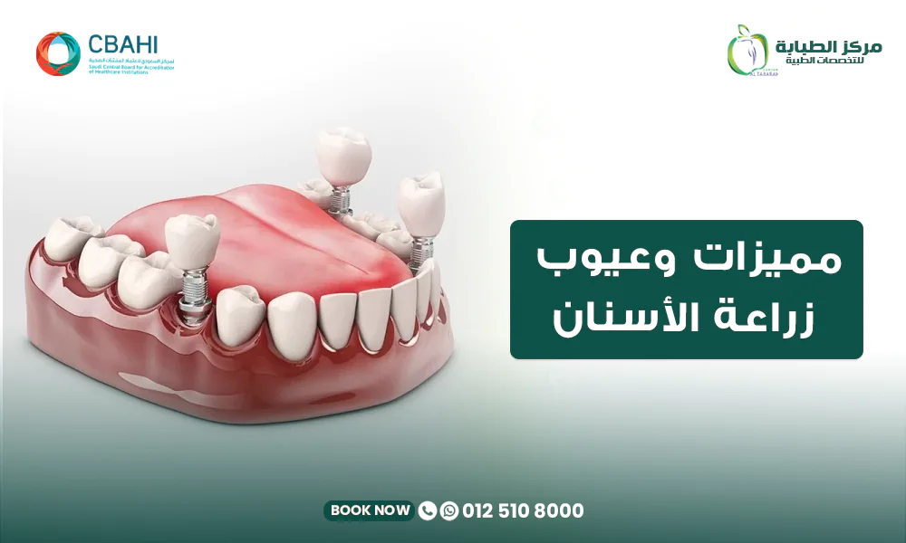 مميزات وعيوب زراعة الأسنان