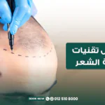أفضل تقنيات زراعة الشعر