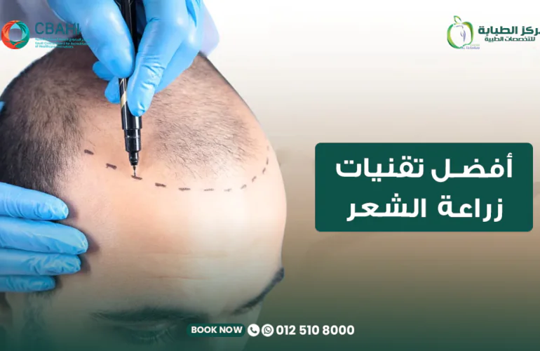 أفضل تقنيات زراعة الشعر