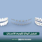 أفضل أنواع تقويم الأسنان