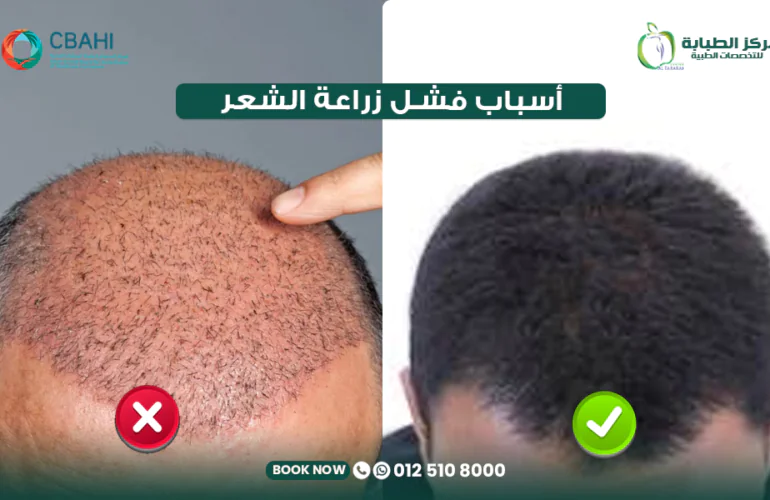 أسباب فشل زراعة الشعر