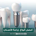 أفضل أنواع زراعة الأسنان