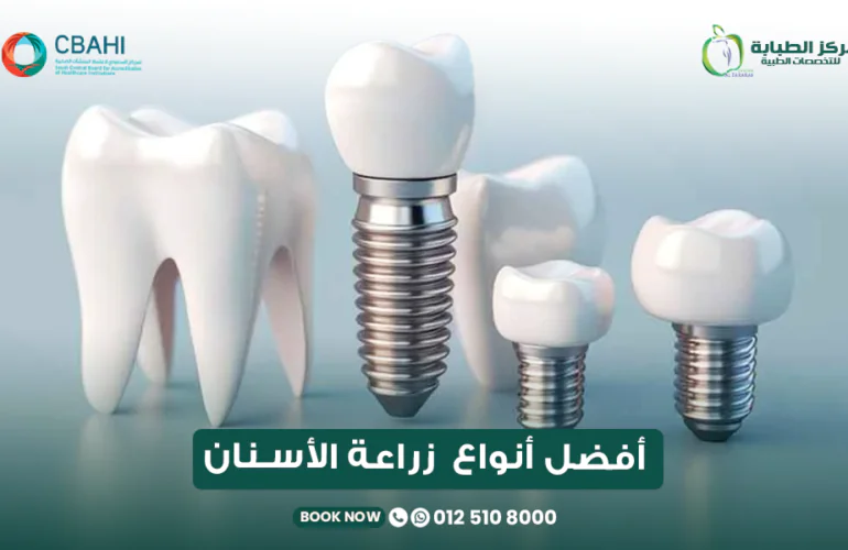 أفضل أنواع زراعة الأسنان