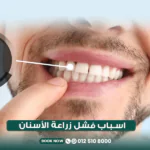 أسباب فشل زراعة الأسنان