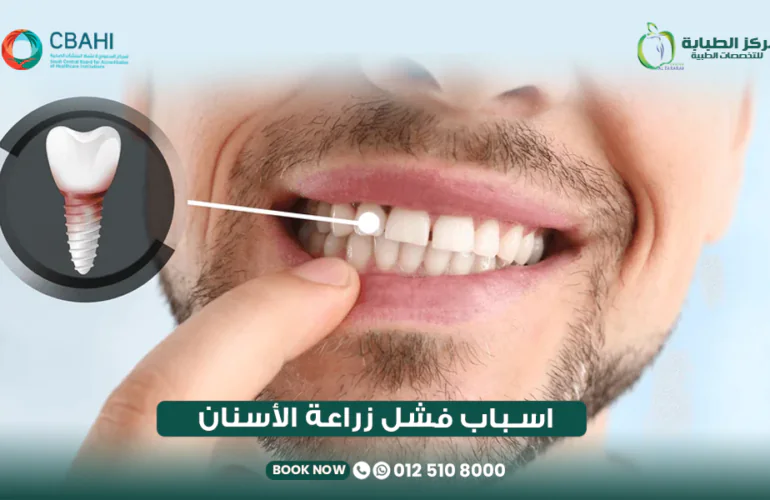 أسباب فشل زراعة الأسنان