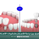 الفرق بين زراعة الأسنان وتركيبات الأسنان