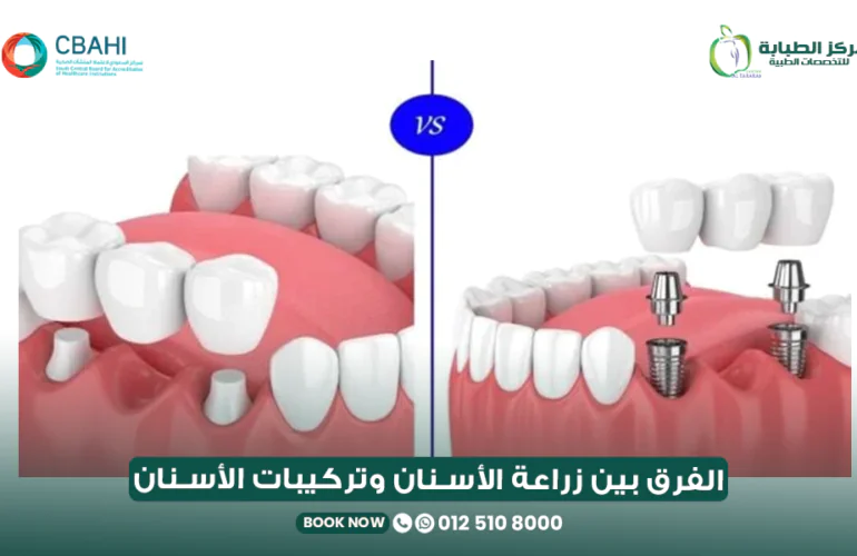 الفرق بين زراعة الأسنان وتركيبات الأسنان: أيهما أفضل؟ 26 الفرق بين زراعة الأسنان وتركيبات الأسنان
