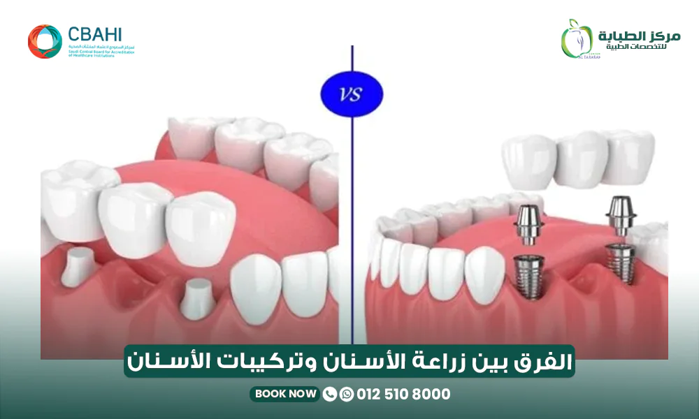 الفرق بين زراعة الأسنان وتركيبات الأسنان: أيهما أفضل؟ 22 الفرق بين زراعة الأسنان وتركيبات الأسنان