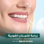 زراعة الأسنان الفورية