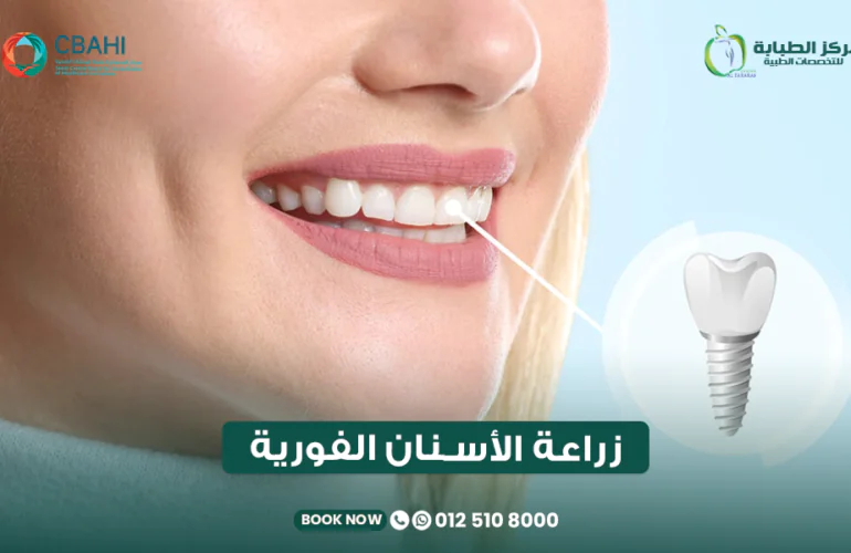 زراعة الأسنان الفورية: المميزات والعيوب والشروط وهل تناسب جميع الحالات؟ 24 زراعة الأسنان الفورية