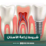 شروط زراعة الأسنان