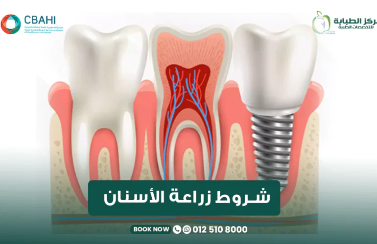 شروط زراعة الأسنان