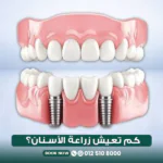 كم تدوم زراعة الأسنان