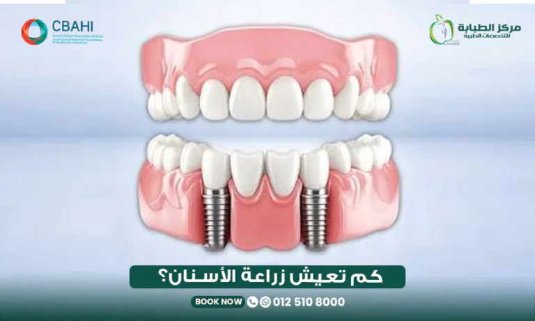 كم تدوم زراعة الأسنان