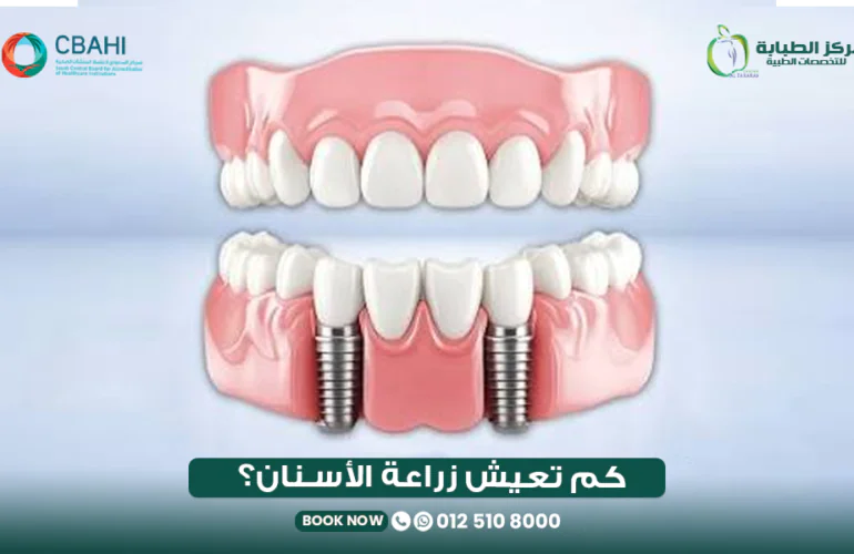 كم تدوم زراعة الأسنان