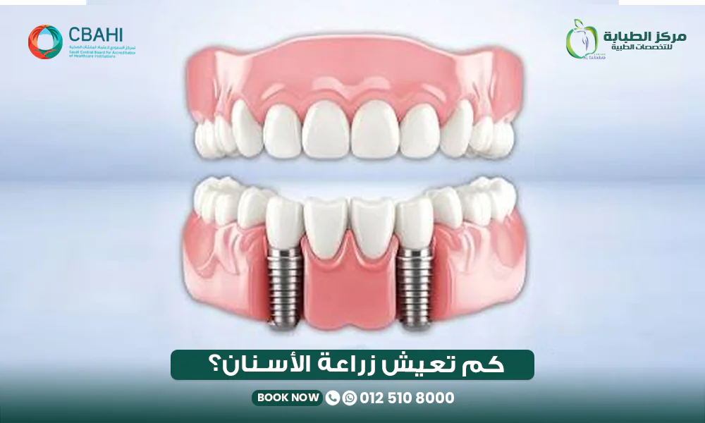 كم تدوم زراعة الأسنان